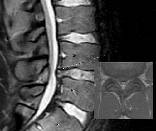 Herniated Disc