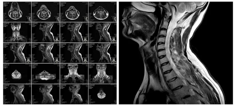 8 Ways To Treat Severe Foraminal Stenosis