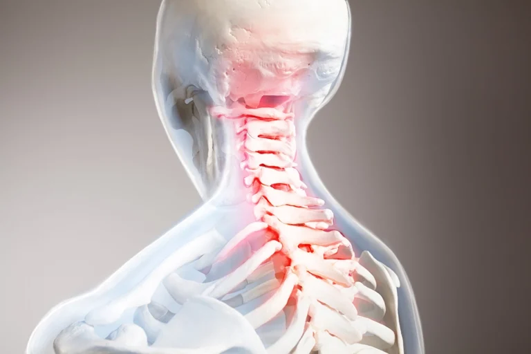 What Things Make Cervical Radiculopathy Worse