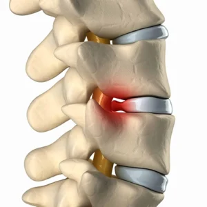 A spine anatomy with highlight on the disks.