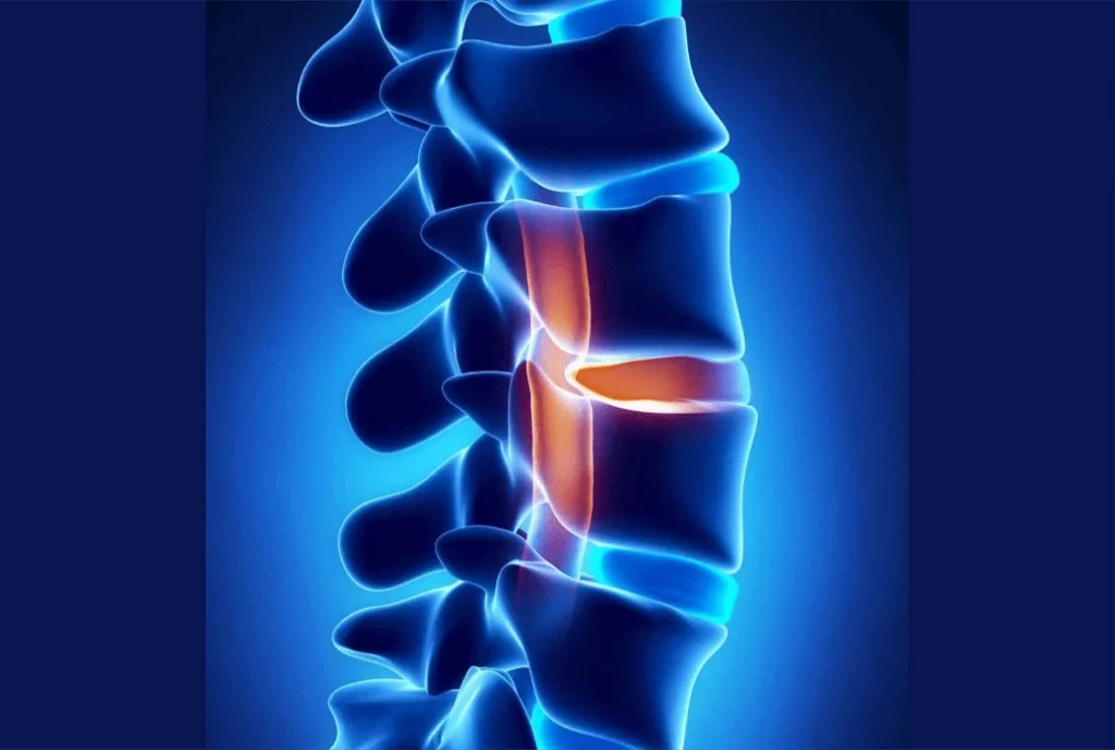 A spine anatomy with highlight on the disks.